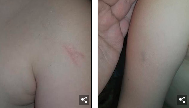 5歲的女孩臉上滿是瘀傷，原來(lái)在校車(chē)上被毆打了45分鐘